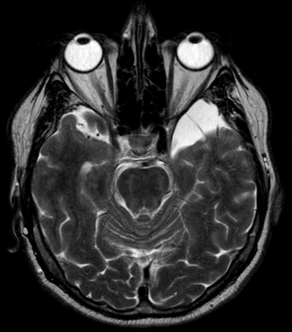 Axial MRI example of an arachnoid cyst.