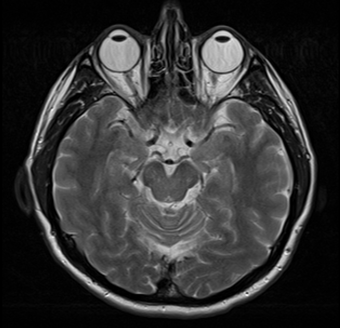 General brain MRI illustration; not a scan of a practice patient or a diagnosis of concussion.