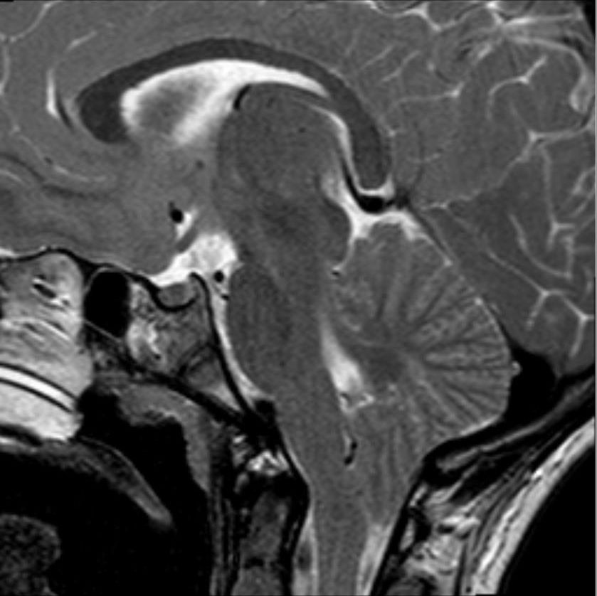 Sagittal MRI example of pediatric Chiari I malformation.