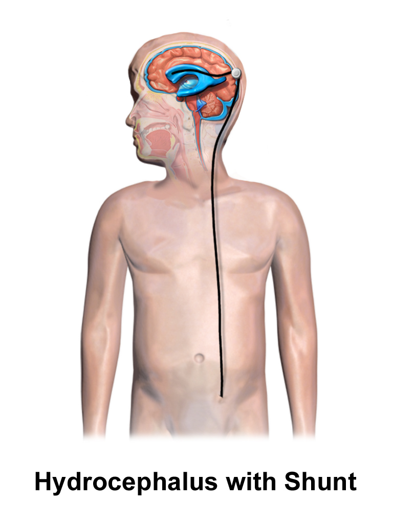 Educational illustration of a ventricular shunt in a child.