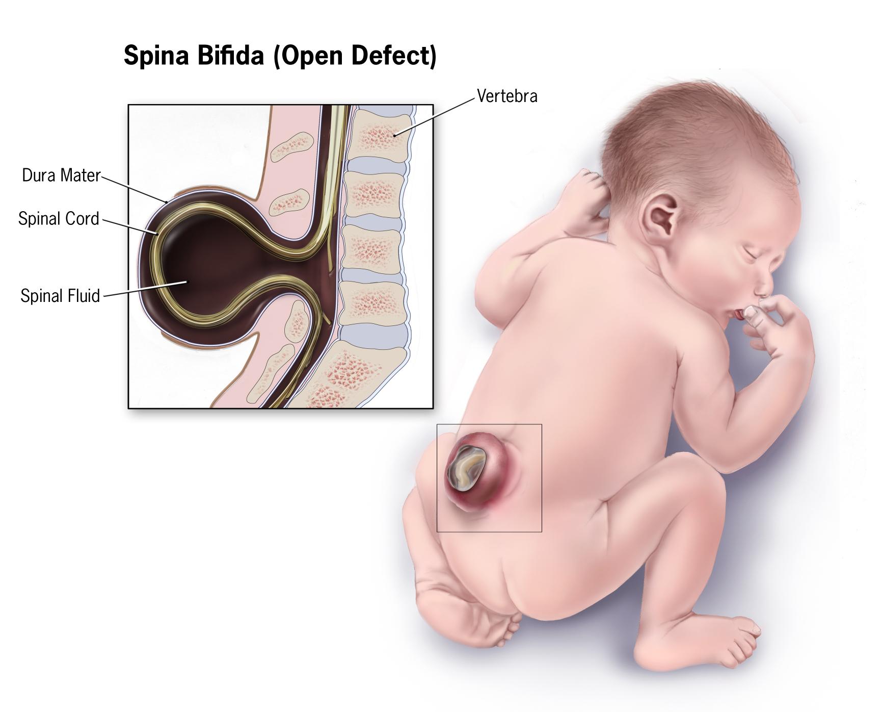CDC educational illustration of spina bifida.